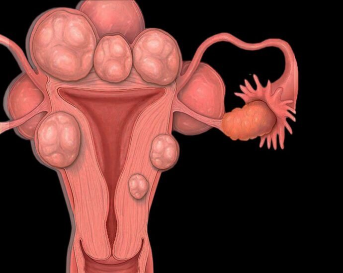 Uterine Fibroids What You Need to Know