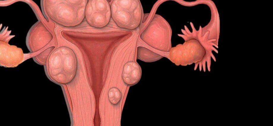 Uterine Fibroids What You Need to Know