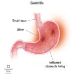 10349-gastritis