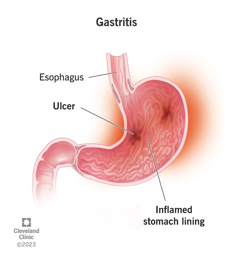 10349-gastritis