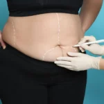 Bariatric Care