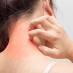 Cervical Migraine