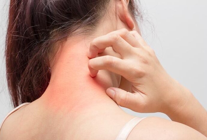 Cervical Migraine