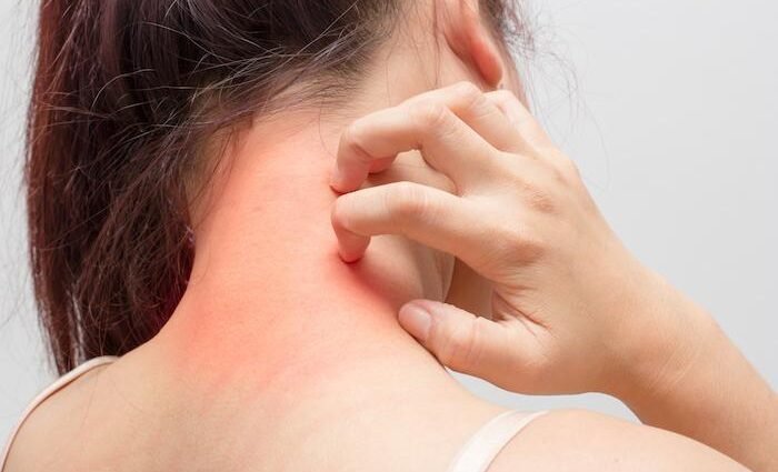 Cervical Migraine