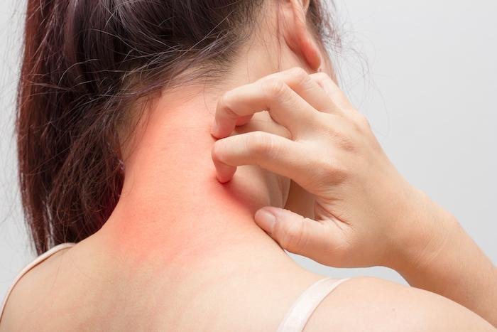 Cervical Migraine