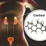 What Are the Symptoms and Causes of High Cortisol Levels