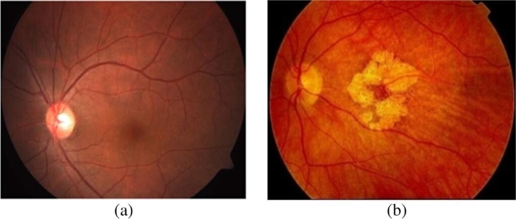 Age-Related Macular Degeneration