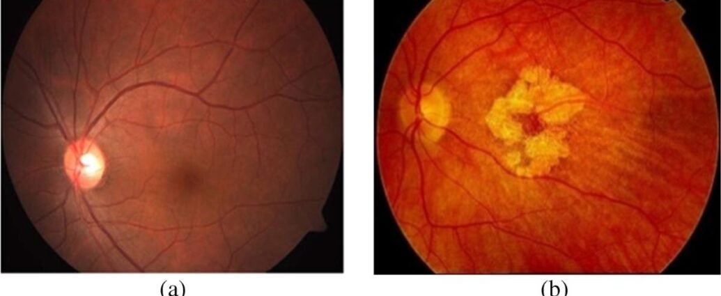 Age-Related Macular Degeneration
