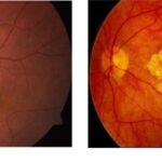 Age-Related Macular Degeneration