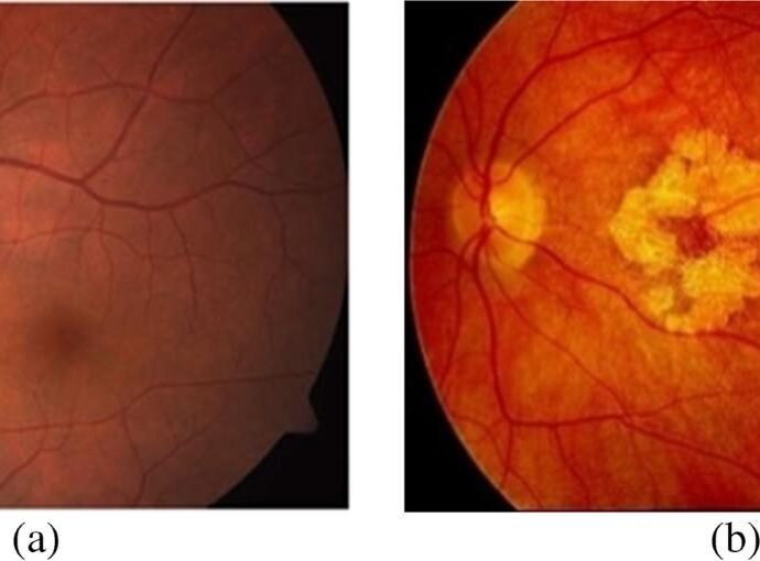 Age-Related Macular Degeneration