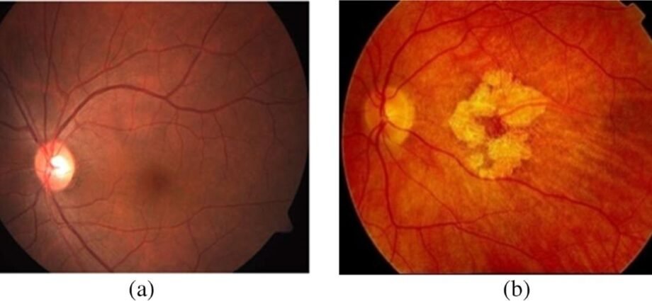 Age-Related Macular Degeneration