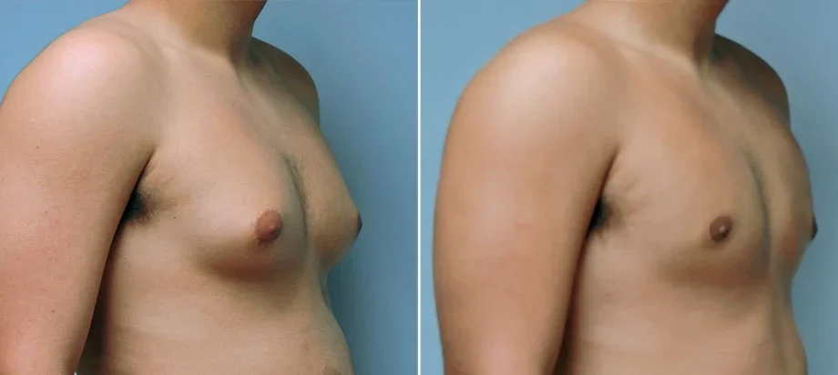 Male Gynecomastia