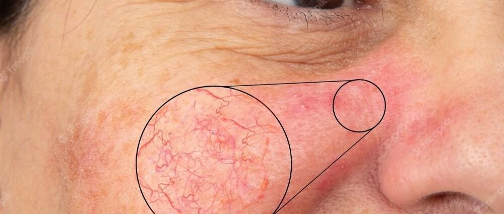 Rosacea
