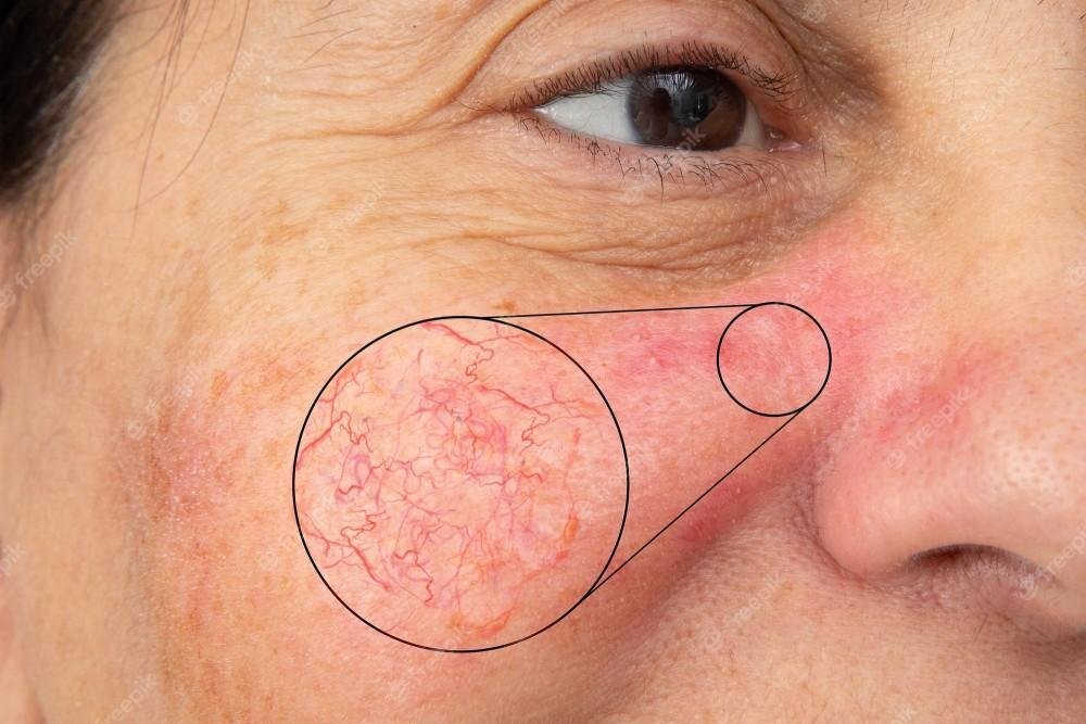 Rosacea
