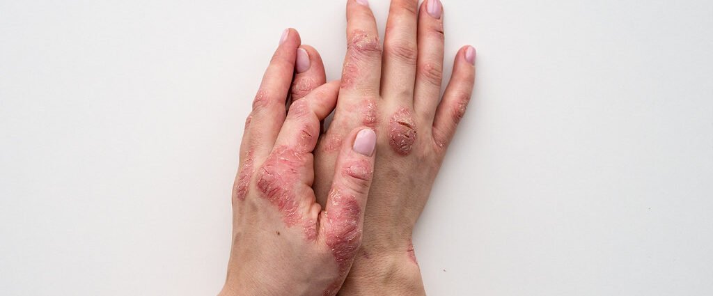 The diet that helps reduce the skin symptoms of psoriasis
