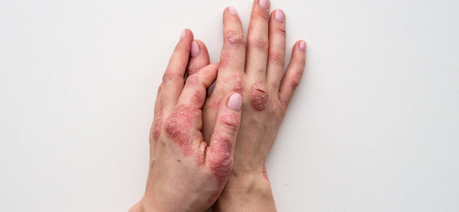The diet that helps reduce the skin symptoms of psoriasis