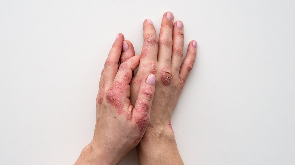 The diet that helps reduce the skin symptoms of psoriasis