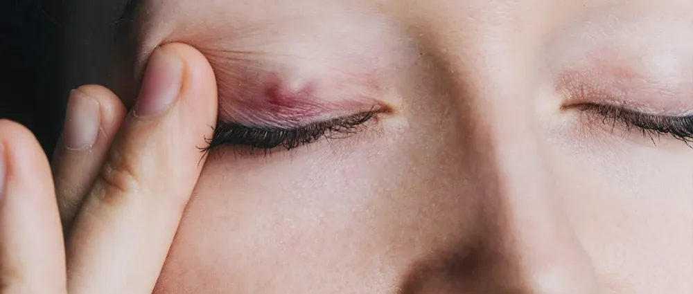 Cystic Stye