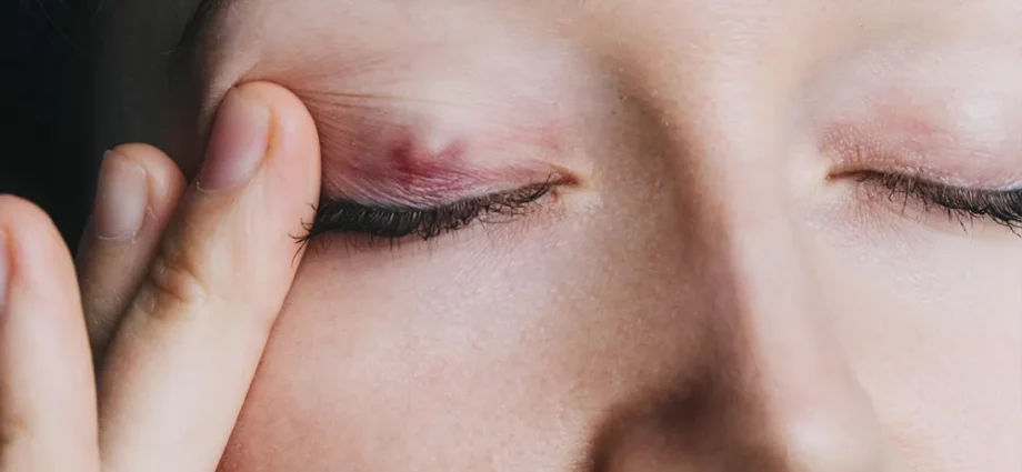 Cystic Stye