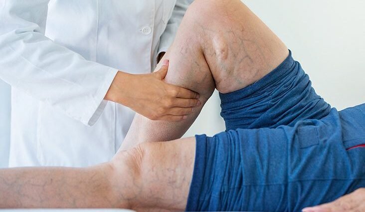 Is It Possible to Prevent Thrombus Through Sports