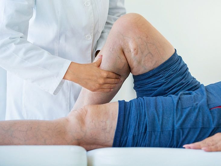Is It Possible to Prevent Thrombus Through Sports